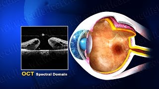 Foro maculare terapia chirurgica wwwoculisticaTVit [upl. by Enoid]