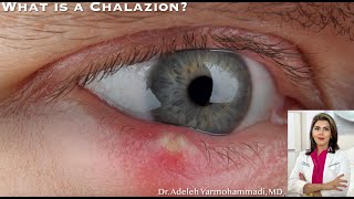 What is a Chalazion quotWhat is that red bump on my eyelidquot [upl. by Lorraine564]