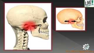 ¿Qué es el síndrome de disfunción temporomandibular ATM [upl. by Ahsikit285]