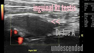 Undescended testis or cryptorchidism inguinal testis sonography ultrasound and color Doppler [upl. by Layla]