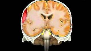 Hematoma Epidural Epidural Hematoma [upl. by Robb]