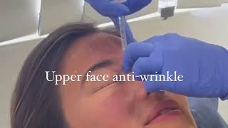 Upper face Anti  Wrinkle Injections Treatment In North Sydney [upl. by Ruffo]