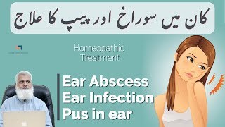 Ear Abscess amp Ear Infection Remedies  Pus in Ear  Otitis Media Treatment [upl. by Arres654]