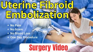 Uterine Fibroid Embolization  Surgery Video [upl. by Annelg614]