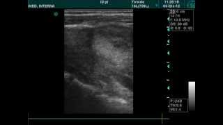 voluminous thyroid nodule ultrasound doppler [upl. by Den]