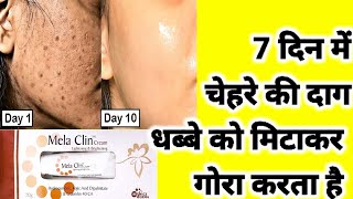 चेहरे को गोरा और चमकदार करता है Mela clin cream review skin lightening cream pigmentation melasma [upl. by Florri]