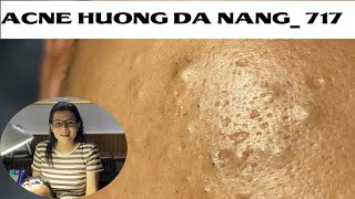 Acne Treatment Huong Da Nang 717  Remove Blackheads [upl. by Gayle810]