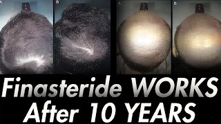 10 YEARS ON FINASTERIDE Results of Italian Study [upl. by Anastos]