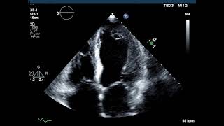 Dilated Cardiomyopathy [upl. by Lodge]