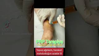 prptherapy topuqağrısı arthrosis [upl. by Odelle]