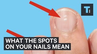 What white marks on nails mean about health [upl. by Rexana]