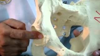 Salter’s innominate Osteotomy in Developemental Dysplastic Hip on Saw Bone Model [upl. by Englis296]