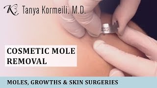 Cosmetic mole removal [upl. by Nilesoj575]