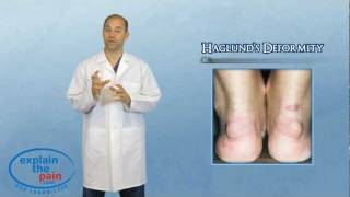 What is Haglunds Deformity or quotPump Bumpquot [upl. by Hollie691]