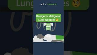 Benign vs Malignant Lung Nodules 🧐 USMLE MedicalEducation Radiology [upl. by Hirsh]