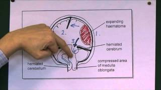 Head Injuries 9 Tentorial herniation [upl. by Elfont]