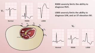 Intro to EKG Interpretation  Bundle Branch Blocks [upl. by Alduino820]