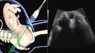 ISUOG how to perform ultrasound in labor assessment of fetal occiput position [upl. by Schiff84]