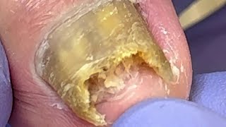 Extremely curly and growing nails infected by onychomycosis bacteria【Doctor Liu Pedicure】 [upl. by Massarelli146]