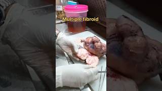 Mutiple fibroid Uterus😨  histopathology ovariancyst fibroiduterus fibroidremoval [upl. by Leahkim]