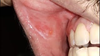 How to clear white patch in the mouth [upl. by Zat]