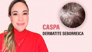 Dermatite Seborreica  a tão temida CASPA [upl. by Lymn858]