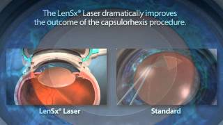 CataractCoach 1218 JampJ Eyhance compared to the Alcon Vivity IOL [upl. by Elolcin795]