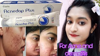 Acnedap plus gel honest review  Best gel for Acne and Pimples  Acne removal  How to use [upl. by Faulkner]