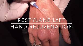 Restylane Lyft Hand Rejuvenation done with cannulas by expert injector Dr Steven F Weiner [upl. by Ladonna199]