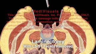 Spondylolisthesis Lumbar Repair [upl. by Kass]