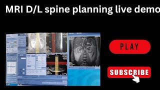 MRI DL Spine scaning and planing live demo How to do MRI DL spine [upl. by Vevina]