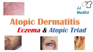 Eczema Atopic Dermatitis  Atopic Triad Triggers Who gets it Why does it happen amp Treatment [upl. by Lawler]