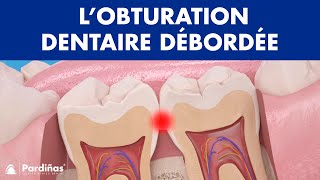 Problèmes de plombage dent – L’obturation dentaire débordée © [upl. by Erena]