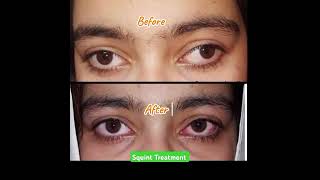 squint strabismus بھینگاپن Treatment eye eyecarecentre eyecare eyecareservices eyecenter [upl. by Akimot]