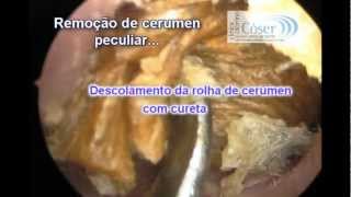 The Biggest Earwax removal by otoendoscopic technique everA Maior cera de ouvido do mundo [upl. by Alur332]