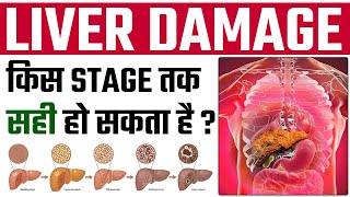 कब होता है Liver Failure   4 Stages Of Liver Disease And Treatment  SRIAAS [upl. by Pape]