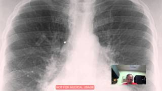 CXR Pulmonary Vascular Congestion Discussed by Radiologistmp4 [upl. by Alel468]