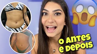 FIZ HIDROLIPO  meu antes e depois e relato de cirurgia [upl. by Atsejam251]