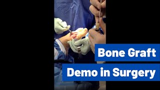 BONE GRAFT DEMO IN SURGERY  Houston Foot Surgeon Using TenSIX DBM by Solana Surgical [upl. by Essilevi]