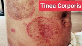 Understanding and Treating Tinea Corporis Expert Guide [upl. by Puff]