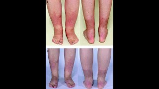 Pretibial Myxedema  definition characteristics causes Symptoms Treatment [upl. by Eleinad912]