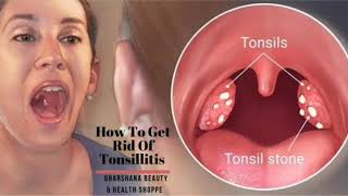 Sign of Tonsillitis Causes Symptoms and Treatment  How To Get Rid Of Tonsillitis [upl. by Airetahs]