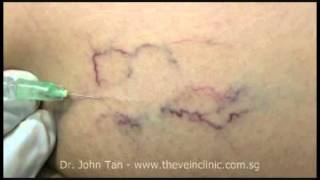 Injection Sclerotherapy [upl. by Retnuh]