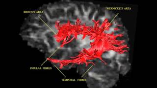 MRIbased diffusion tensor imaging DTI and tractography [upl. by Craddock926]