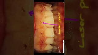 Laser gingivectomy [upl. by Quiteris]