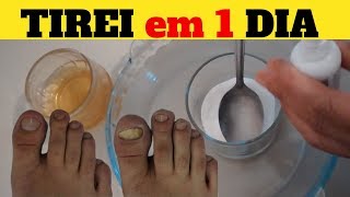 TIREI em 1 Dia MICOSE FUNGOS BACTÉRIA das Unhas Tratamento Caseiro Bicarbonato e Vinagre de Maça [upl. by Suoirrad14]