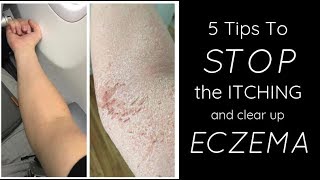 HEALING ECZEMA  5 Things I Do Each Day To STOP THE ITCH [upl. by Kung]