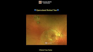 Operculated Retinal Tear [upl. by Steinberg]