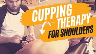 Cupping Therapy Techniques for the Shoulder [upl. by Ahsyas640]