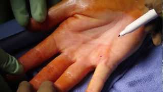 5 Dupuytrens Contracture [upl. by Ringe]